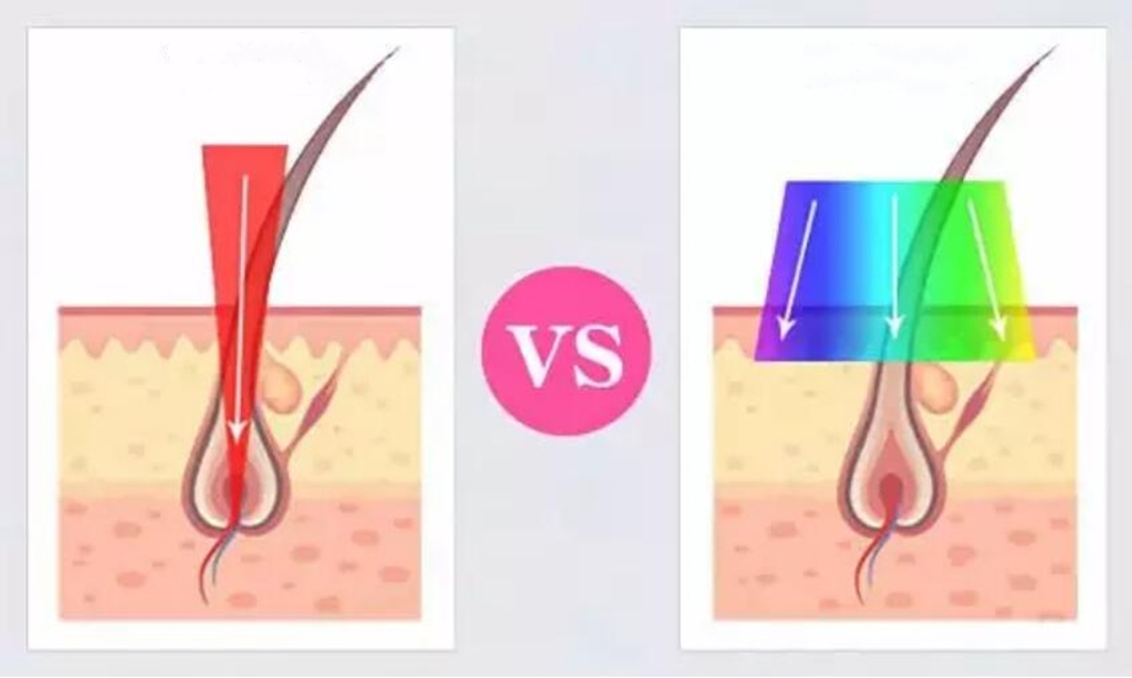 Diode Laser VS IPL,Which Is Right for Your Beauty Salon Business